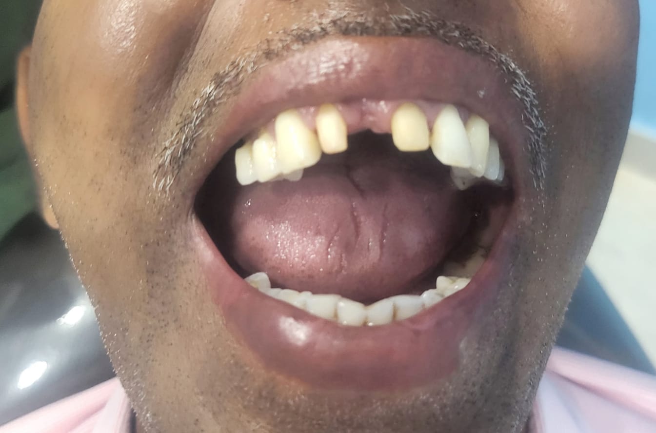 after implant service in smile return dental clinic